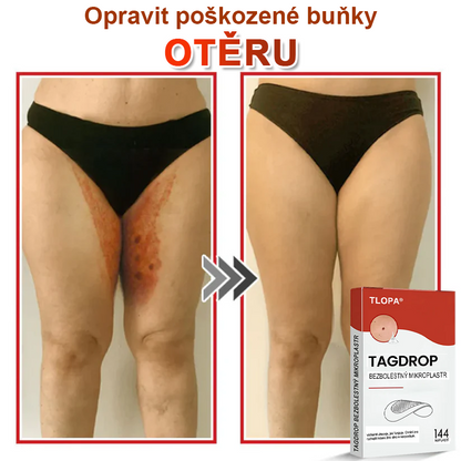TLOPA® Mikrovpichová botanická náplast na odstranění kožních výrůstků 🇨🇿 Vyrobeno v Česká republika🇨🇿