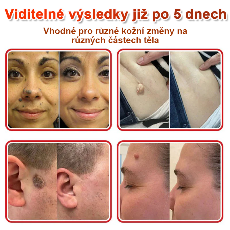 TLOPA® Mikrovpichová botanická náplast na odstranění kožních výrůstků 🇨🇿 Vyrobeno v Česká republika🇨🇿