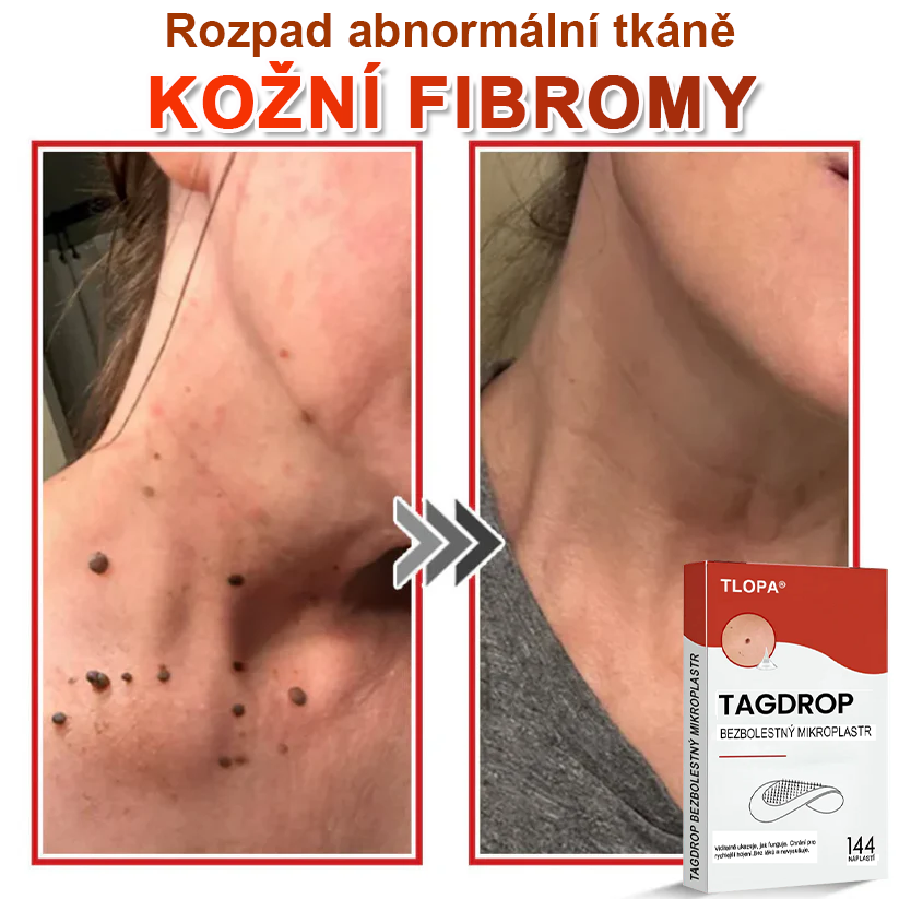 TLOPA® Mikrovpichová botanická náplast na odstranění kožních výrůstků 🇨🇿 Vyrobeno v Česká republika🇨🇿
