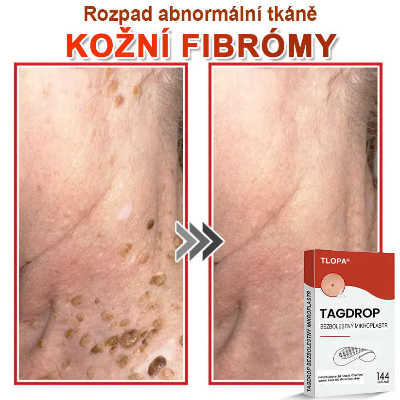 TLOPA® Mikrovpichová botanická náplast na odstranění kožních výrůstků 🇨🇿 Vyrobeno v Česká republika🇨🇿