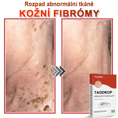 TLOPA® Mikrovpichová botanická náplast na odstranění kožních výrůstků 🇨🇿 Vyrobeno v Česká republika🇨🇿