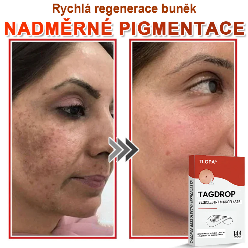 TLOPA® Mikrovpichová botanická náplast na odstranění kožních výrůstků 🇨🇿 Vyrobeno v Česká republika🇨🇿