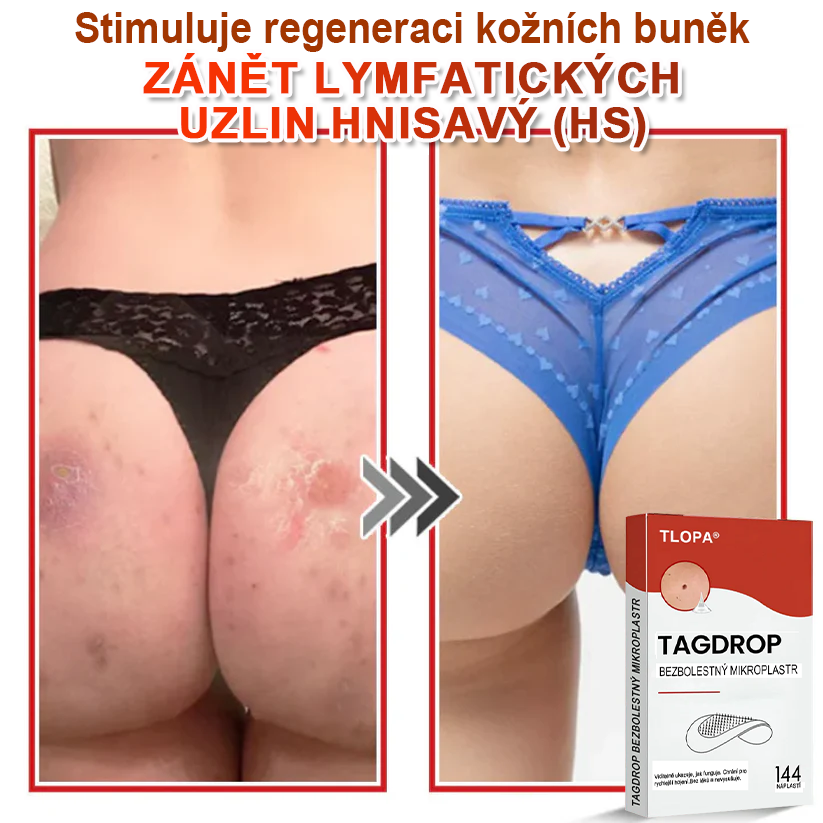 TLOPA® Mikrovpichová botanická náplast na odstranění kožních výrůstků 🇨🇿 Vyrobeno v Česká republika🇨🇿