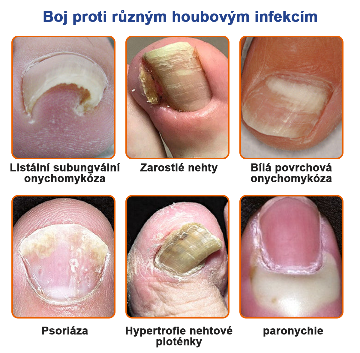 🐝🐝Furzero™ Včelí jed na plíseň nehtů: kompletní řešení plísně nehtů 🌟👣👣