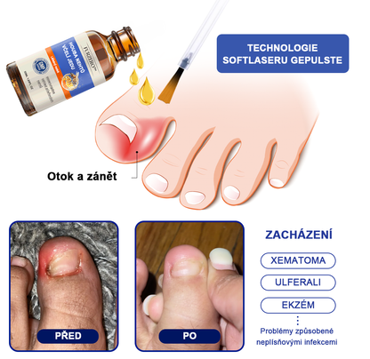 🐝🐝Furzero™ Včelí jed na plíseň nehtů: kompletní řešení plísně nehtů 🌟👣👣